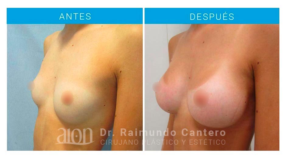 medio-aumento-senos-protesis-anatomicas-raimundo-cantero-new