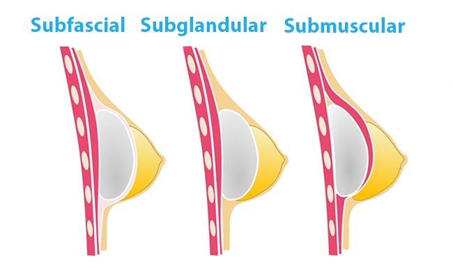 Vias colocación prótesis mamarias en operación de pecho