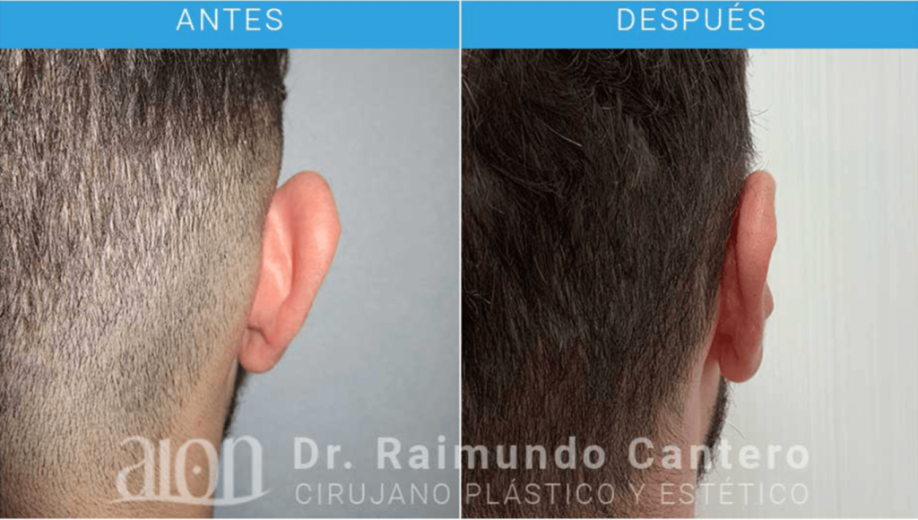 operacion de orejas precio malaga