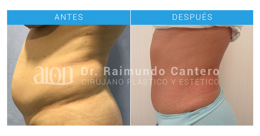 perfil-abdominoplastia-malaga-dr-cantero