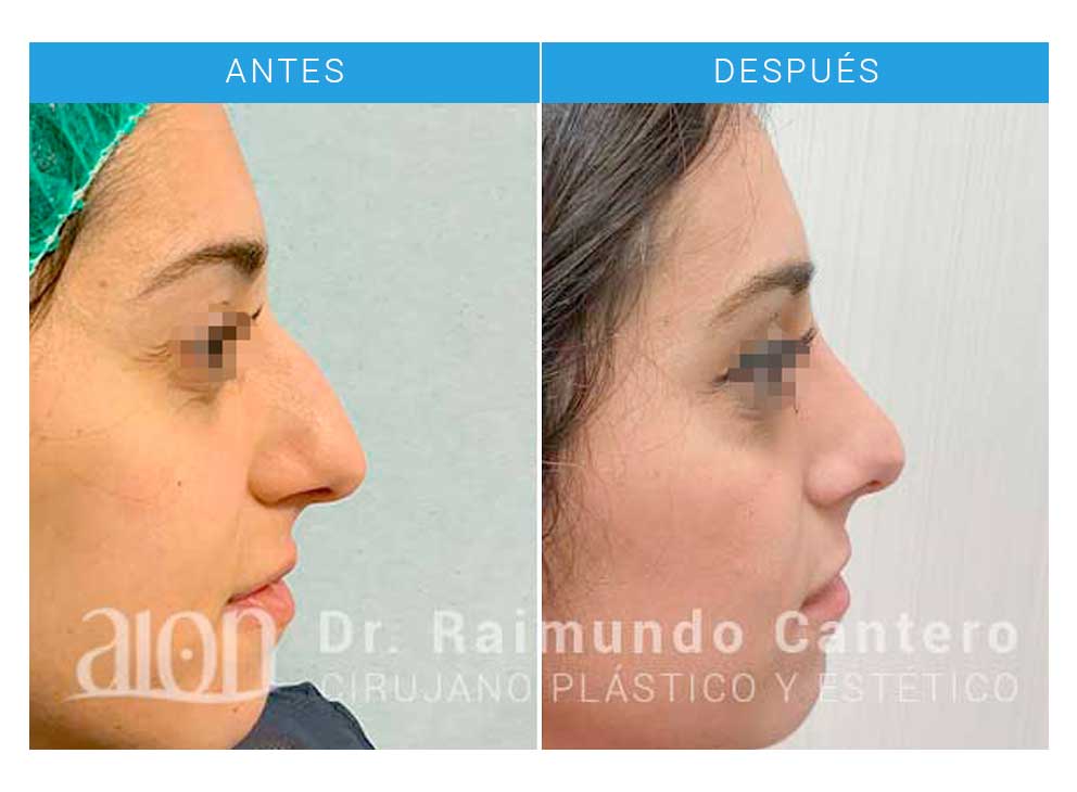 resultados rinoplastia malaga