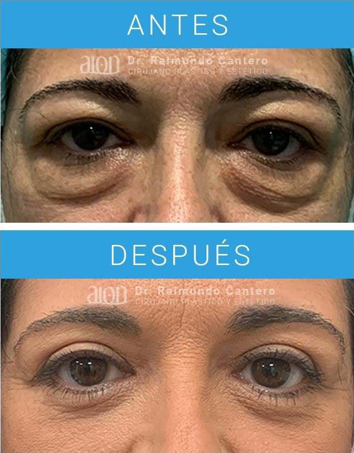 resultados de blefaroplastia malaga
