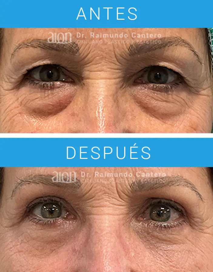 cuanto cuesta una blefaroplastia en malaga