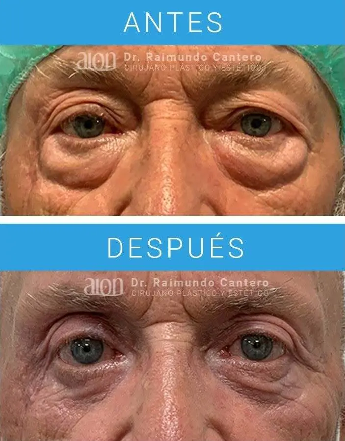 antes y despues blefaroplastia malaga