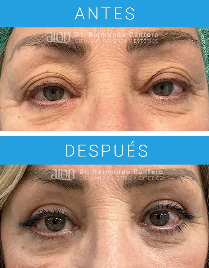 blefaroplastia laser co2 malaga