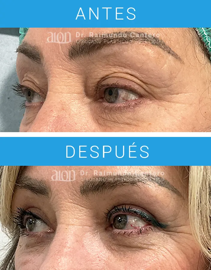 mejor cirujano blefaroplastia malaga
