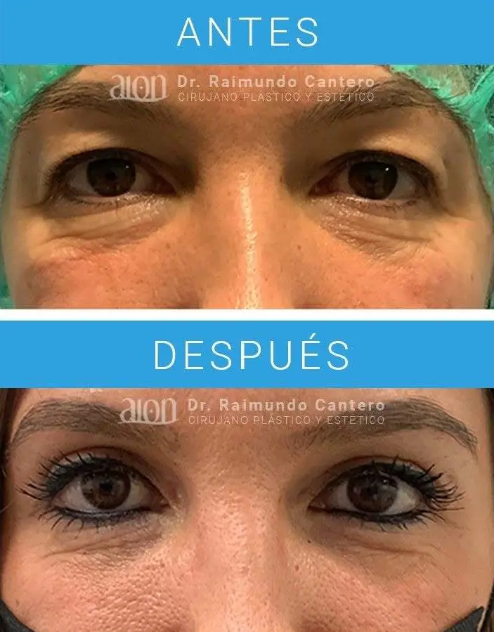 antes y despues blefaroplastia malaga
