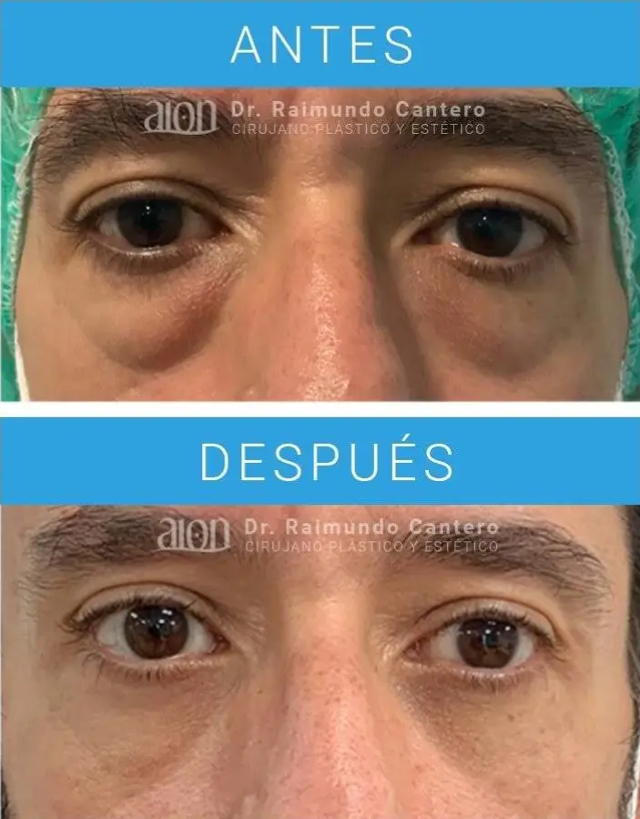 resultados de blefaroplastia malaga