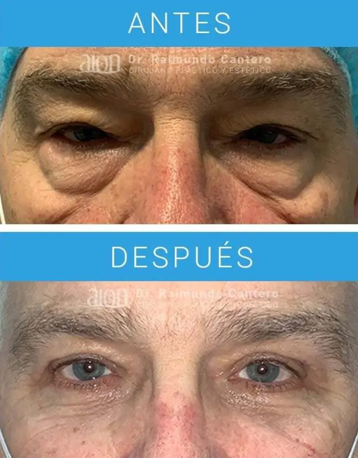 antes y despues blefaroplastia malaga