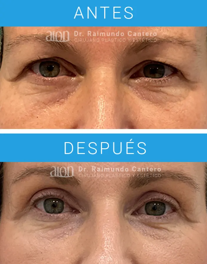antes y despues blefaroplastia malaga