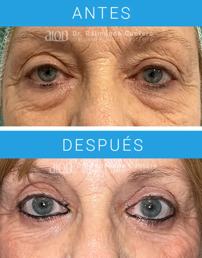 blefaroplastia quiron malaga