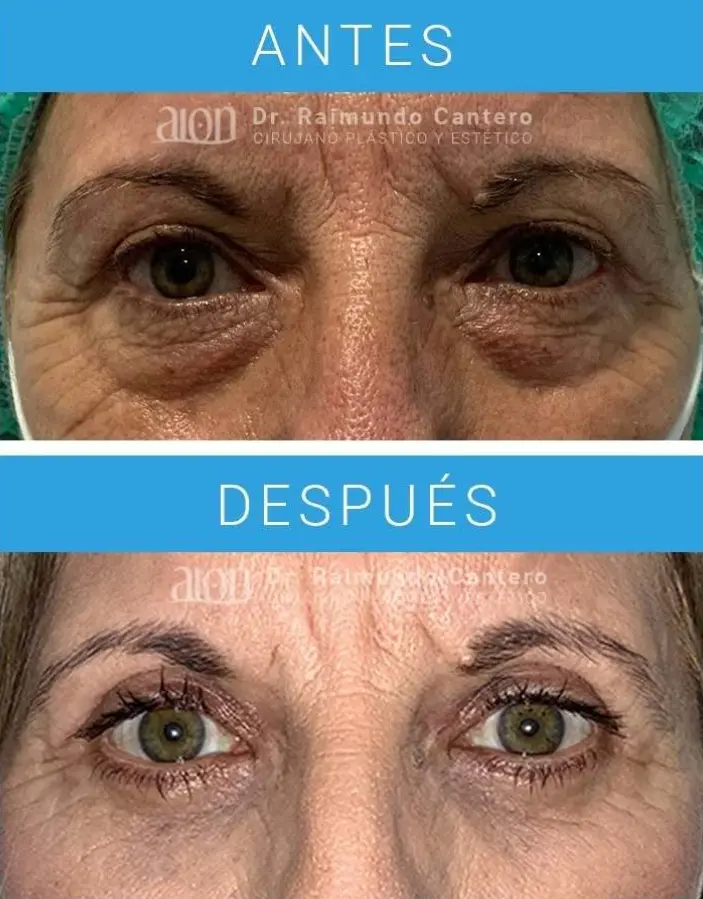 blefaroplastia malaga precios