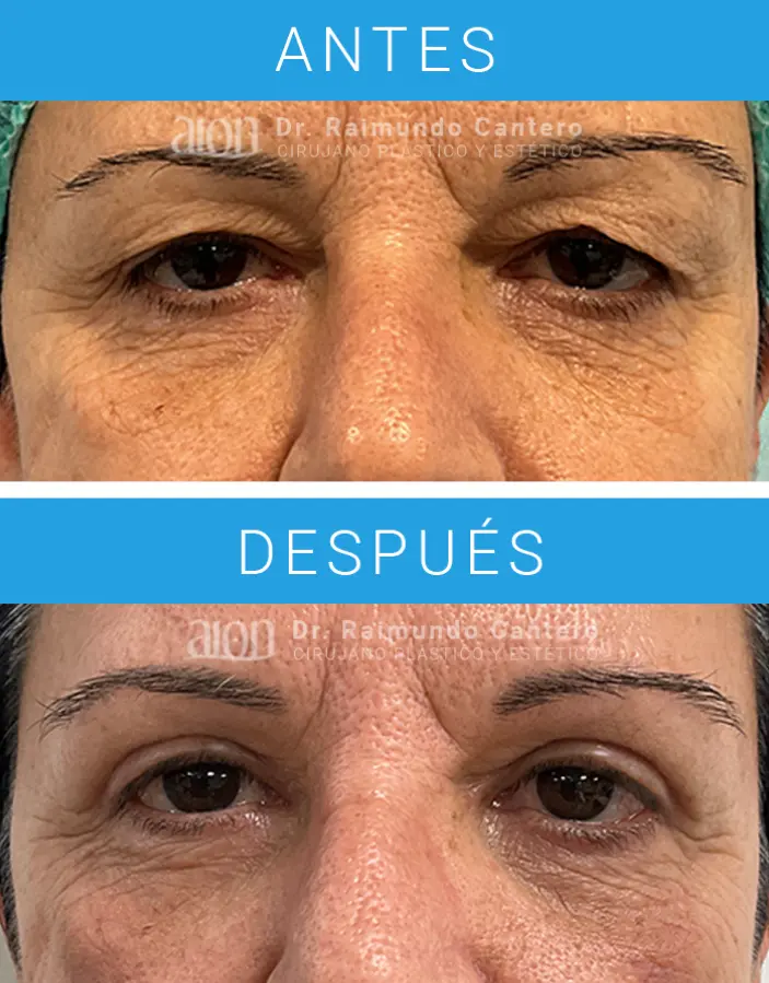 blefaroplastia laser co2 malaga