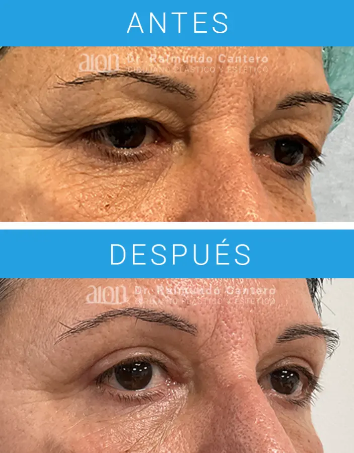 mejor cirujano blefaroplastia malaga