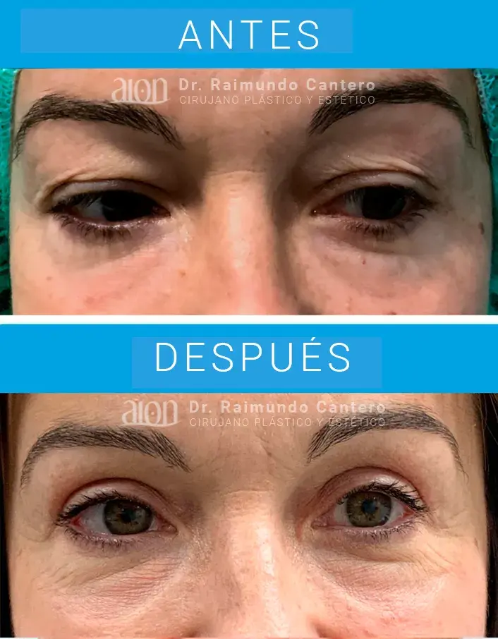 blefaroplastia en malaga opiniones