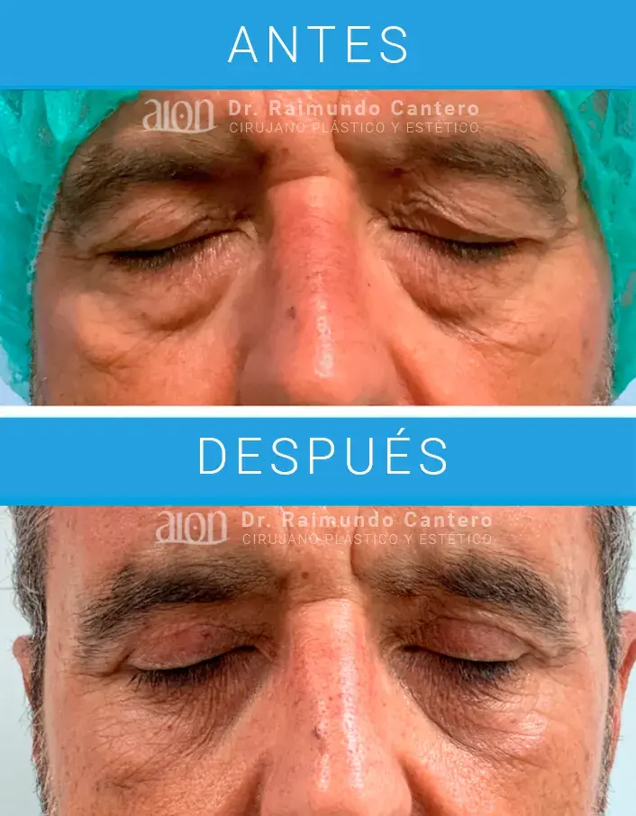 blefaroplastia malaga opiniones
