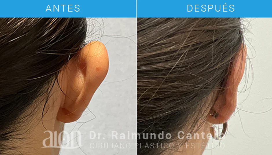 antes y despues operacion de orejas mujer en malaga