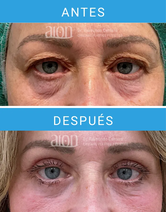Antes y después operación blefaroplastia en Málaga en mujer