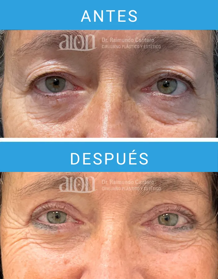 antes y después blefaroplastia en mujer en Málaga
