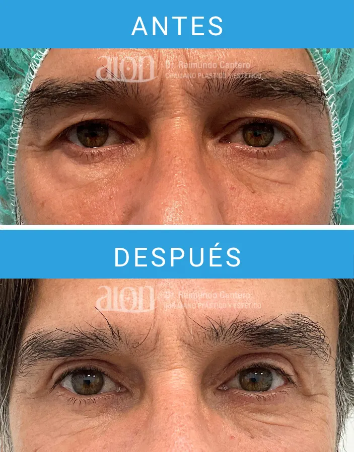 resultado blefaroplastia superior en hombre en Málaga